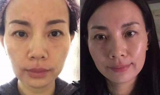 美容除皱方法 美容除皱方法有哪几种
