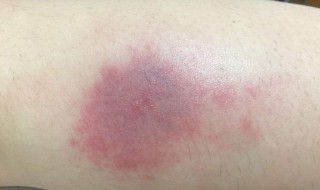蚊子咬了红肿怎么止痒（被蚊子咬了红肿怎么止痒）