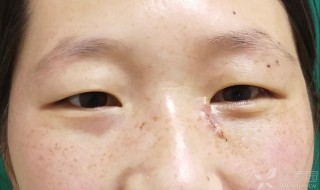 眼角有痣代表什么 女人右眼角有痣代表什么