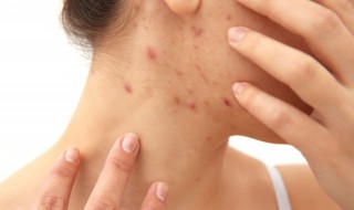 最快祛痘方法（最快祛痘方法有哪些）