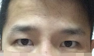 怎样去眼角纹 什么办法可以去眼角纹