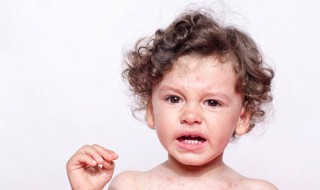 孩子头上长虱子怎么办 孩子头上长虱子怎么办虫卵怎样去除