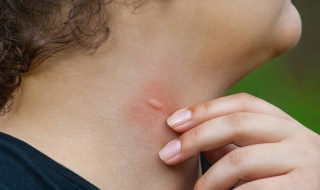 被蚊子咬后第二天起包吗（为什么蚊虫叮咬后第二天才起包）