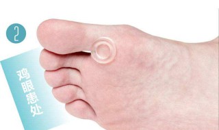 什么是鸡眼 什么是鸡眼睛