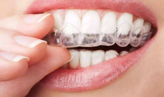 牙套适合年龄 牙套适合年龄段是多少