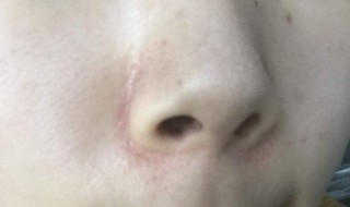 脸上有黑头怎么办（13岁女孩脸上有黑头怎么办）