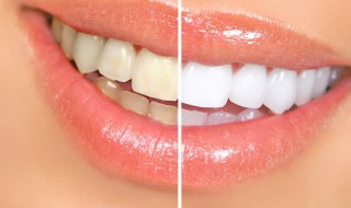 牙齿发黄怎么办（牙齿发黄怎么办?）