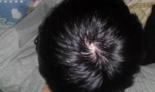 脱发了如何能让头发再生（脱发了如何能让头发再生起来）