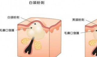 脸上粉刺闭口怎样消除 脸上粉刺闭口怎样消除最快