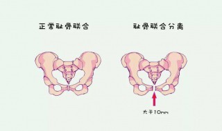 耻骨在哪个位置 耻骨在哪个位置示意图
